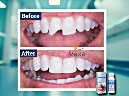 VexaSmile™ - Professional DIY Tooth Repair Kit